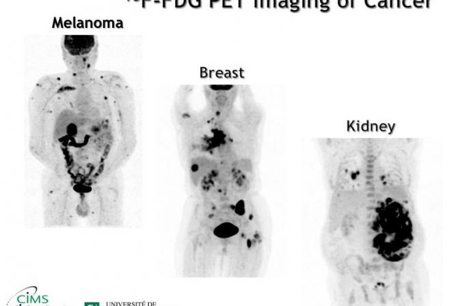 18F-FDG PET Imaging of Cancer-Melanoma, Breast and Kidney
