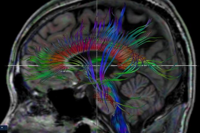 Image transversale d'un cerveau
